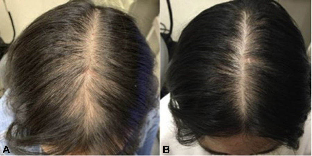 Hair Regrowth Serum-with Peppermint Oil, Tea Tree Oil, Argan oil, Jojoba seed, Avocado oil, Castor oil, Sweet Almond, Vitamin E Oil for Scalp and Hair
