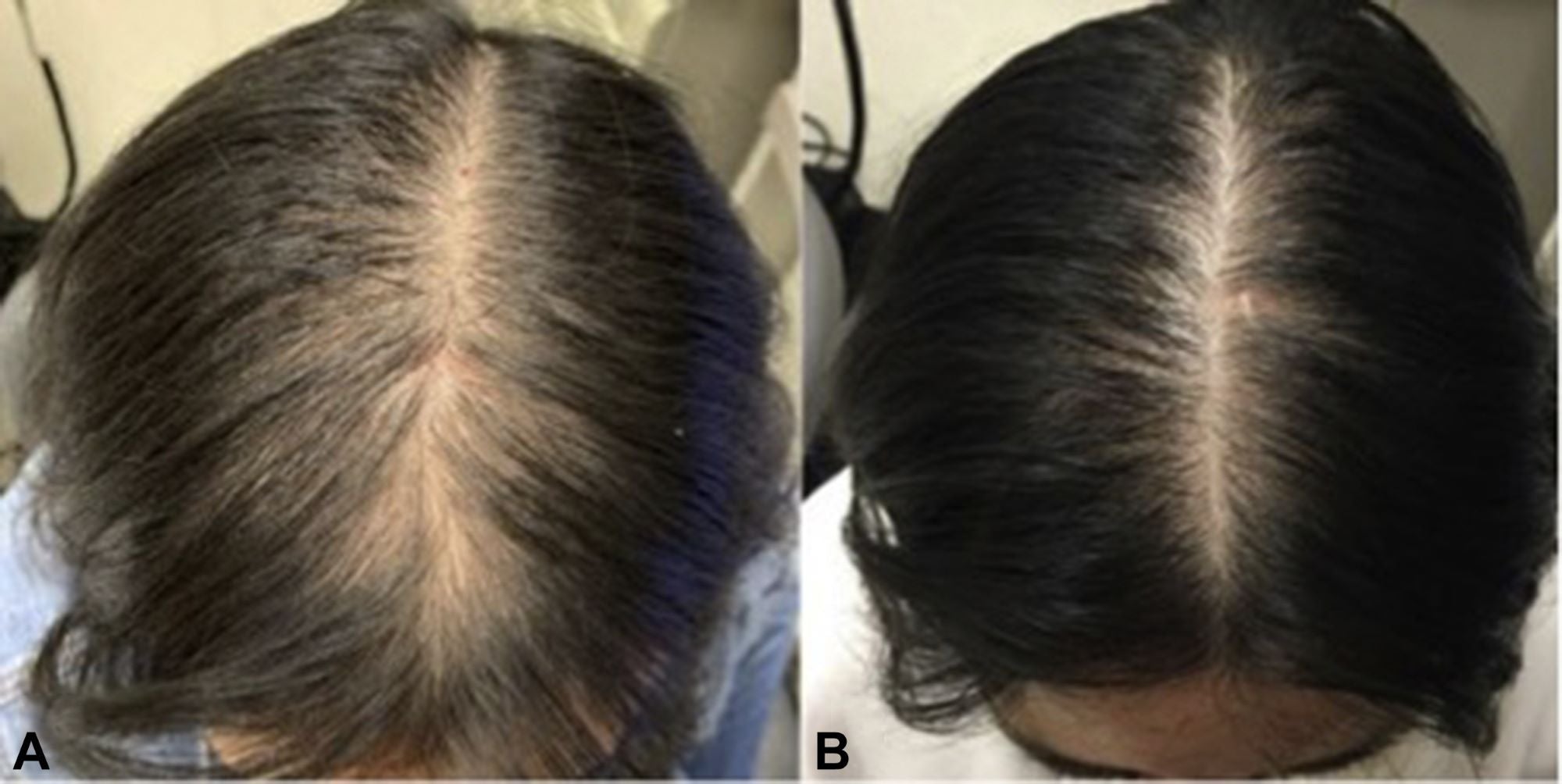 Pro Growth-Alopecia Anti-Thinning Hair Growth- With Haitian Vetiver-Jojoba Seed-Biotin- Argan-Peppermint Oil, Tea Tree Oil, Argan oil-P